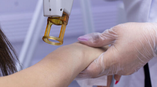 epilation laser bras geneve